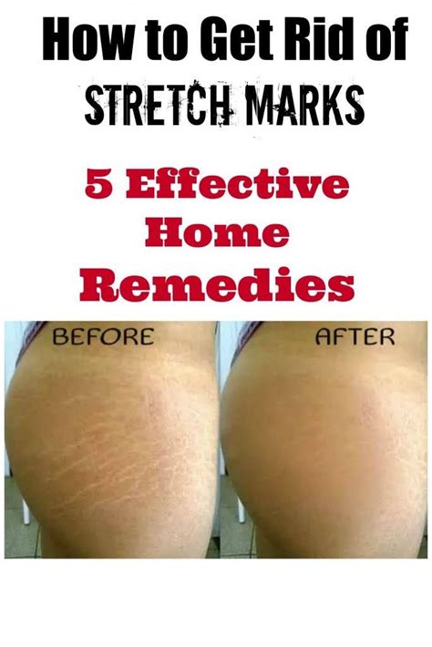 How To Get Rid Of Stretch Marks 5 Effective Home Remedies Stretch Marks Stretch Mark