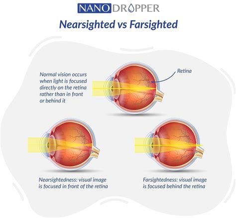 Whats The Difference Between Being Nearsighted And Farsighted