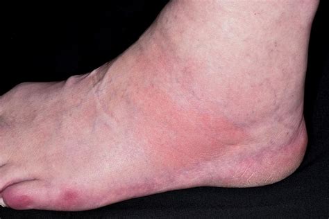 Gout Swollen Foot And Ankle