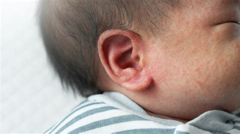 Ear Eczema Symptoms And Treatments Goodrx