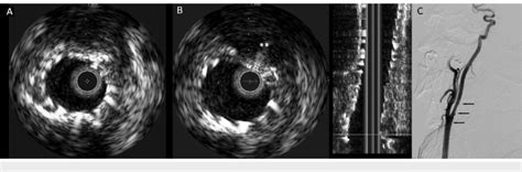 Intravascular Ultrasound And Digital Subtraction Carotid Angiogram Of