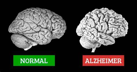Alzheimer's Know the wellbeing gambles related with this condition