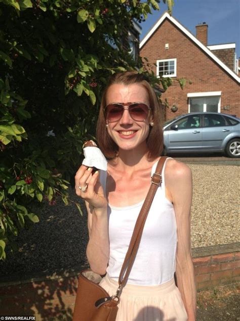 Recovering Anorexic Turned Down For Nhs Treatment After Being Deemed ‘too Fat Real Fix