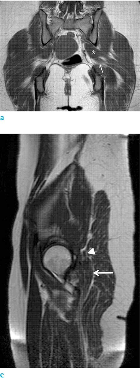 Figure 2 From Accessory Belly Of The Piriformis Muscle As A Cause Of Piriformis Syndrome A Case