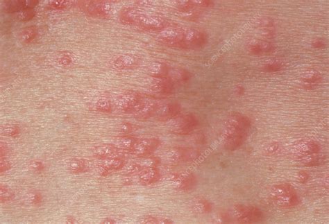 Red Papules On The Skin Due To Scabies Stock Image M2600127