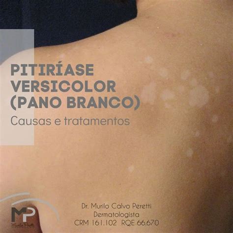 Pitiríase Versicolor Pitiríase Versicolor é Uma Micose Superficial Da