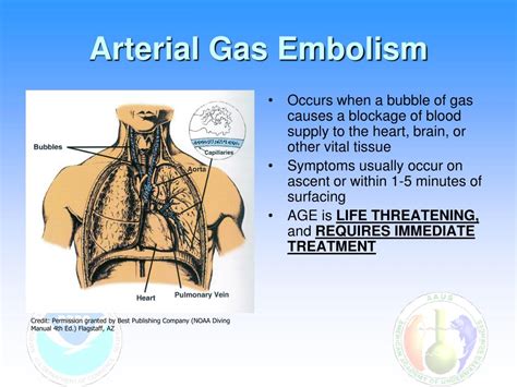 Arterial Embolism Pictures