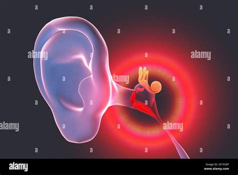 Otitis Media Ear Infection Illustration Stock Photo Alamy