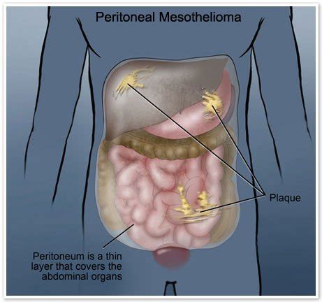 The pain or discomfort can be caused by the tumour invading nerves or organs that lie near the pancreas. Mesothelioma Pictures | Mesothelioma Cancer Alliance Photo ...