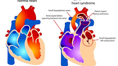 Hypoplastic Left Heart Syndrome Symptoms Hear Choices
