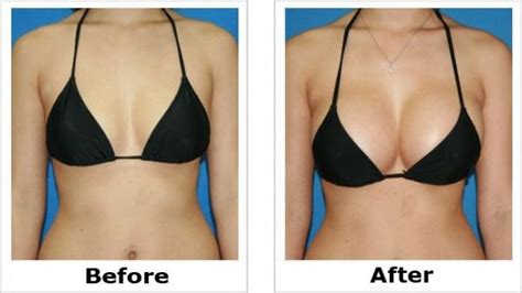 A To B Breast Implants Porn Pics Sex Photos Xxx Images Fatsackgames