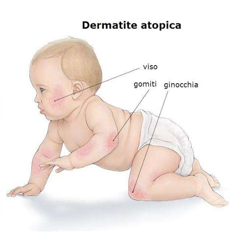 Eczema o dermatite atopica nei neonati e nei bambini Perché non prendere in considerazione