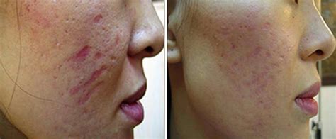 Before And After Dermapen Treatments At Cheshire Lasers Middlewich