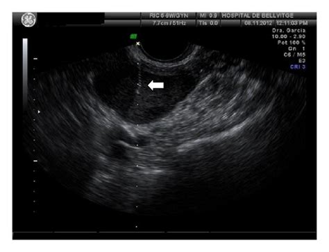 Transvaginal Ultrasound Guided Aspiration Of An Endometrioma A Hot
