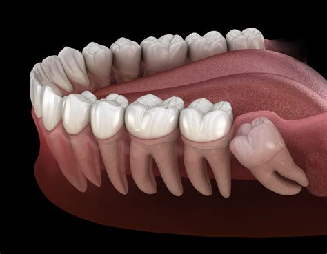 Molars And Wisdom Teeth Function And Problems