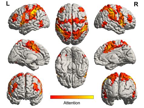 Music Activates Regions Of The Brain Spared B Eurekalert