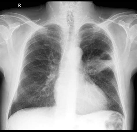 Cavitating Lung Cancer Image