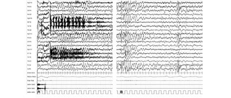 A Interictal Eeg During Wakefulness Showing Bilateral Frontal And