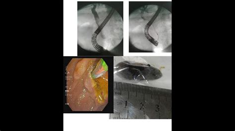 Ercp With Stone Extraction Dhakaendoscopy Endoscopy Please