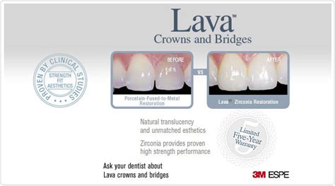 The average cost of a dental bridge is $500 to $900 per tooth. Zirconia Ceramic Dental Bridge Cost ..........................Famous best Cosmetic Implants ...