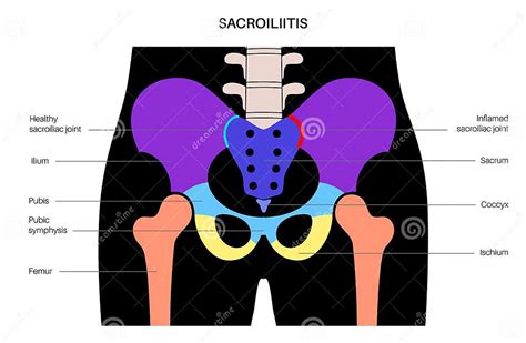 Sacroiliitis Medical Poster Stock Vector Illustration Of Condition