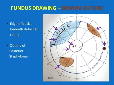 Looking Deep Into Retina Indirect Ophthalmoscopy And Fundus Drawing