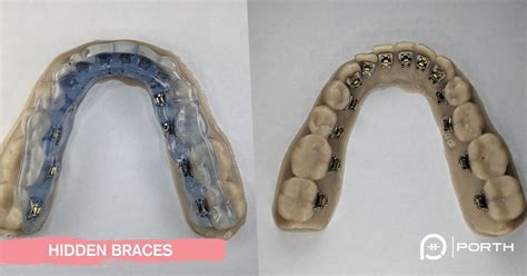 Learn Everything About Hidden Braces Top Orthodontist Insights