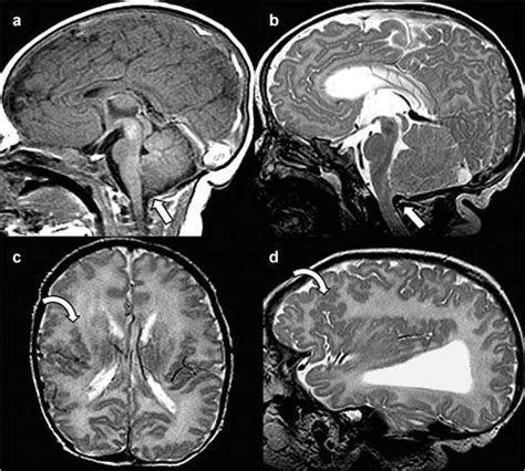 T1 Weighted Sagittal Mri In The Neonatal Period A Demonstrates