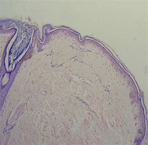 Photomicrographs Of A Hyperpigmented Lesion Showing Mild Acanthosis