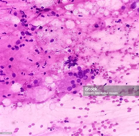 Fna Cytology Of Swelling Of Chest Wall Infected Epidermal Inclusion