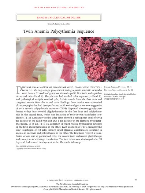 Pdf Twin Anemia Polycythemia Sequence