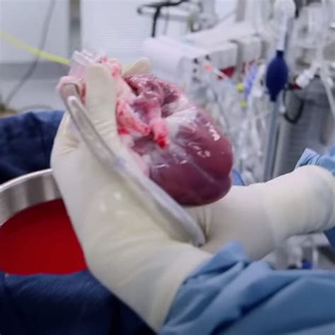 Heart Transplantation Primary Anatomy