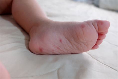Can I Keep My Kids Safe From Hand Foot And Mouth Disease Dyosa The