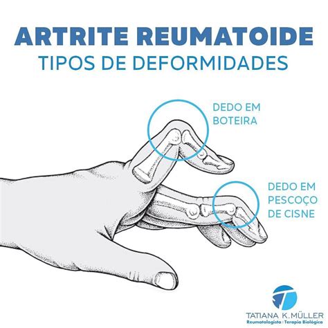 Artrite Reumatoide Tipos De Deformidades Artrite Reumatoide