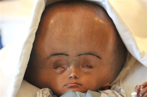 Roona Begum Indian Girl With Severe Hydrocephalus To Have Life Saving