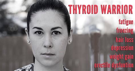 Hypothyroidism Causing Excess Facial Hair