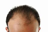 Hair Thinning Treatment Male Photos
