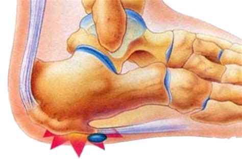 Heel Spur Conditions Eastpoint Podiatry Edgecliff Nsw