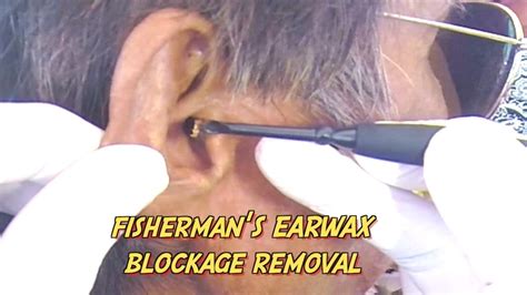 Fishermans Earwax Blockage Removal Youtube