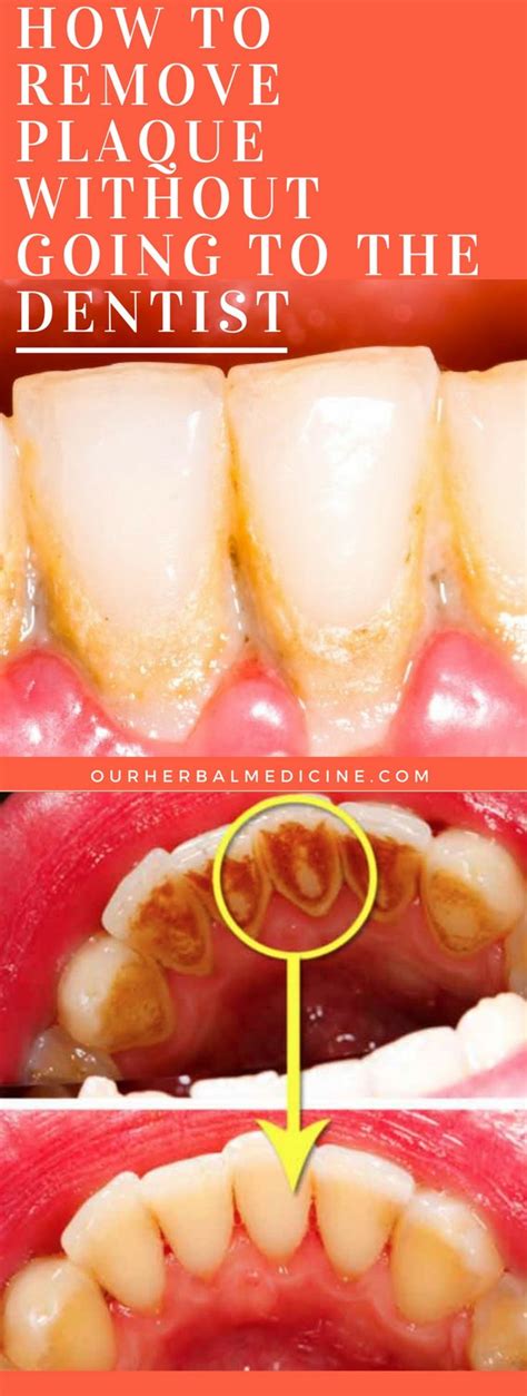 How To Remove Plaque Without Going To The Dentist Herbal Medicine