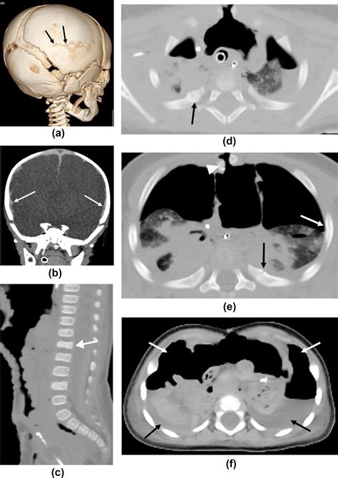 Forensic Post Mortem Ct In Children Clinical Radiology