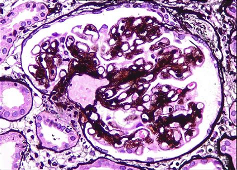 Glomerulus Of A Young Man With Membranous Glomerulonephritis Showing