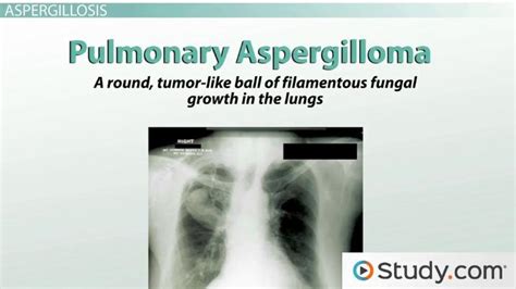 What Is Aspergillosis Fungal Infections And Symptoms Lesson