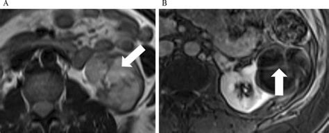 Axial T2 A And T1 Fat Saturated Fs B Mri In A 25 Year Old With