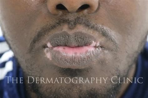 Vitiligo On Lips Before And After