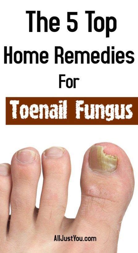 The 5 Top Most Home Remedies For Toenail Fungus Toenail Fungus