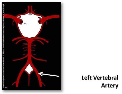 Left Vertebral Artery The Anatomy Of The Arteries Visual Flickr
