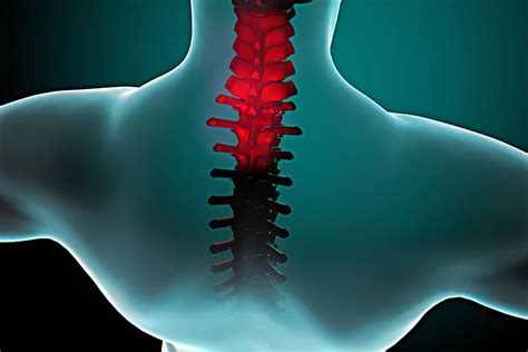 Stiff Neck Causes And Treatments Arizona Pain And Spine Institute