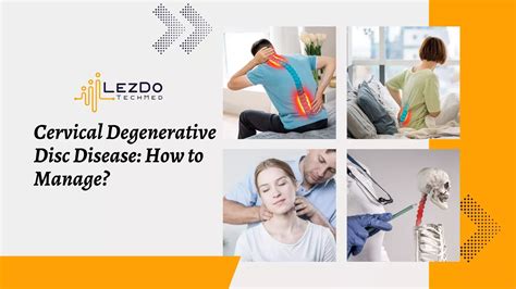 Cervical Degenerative Disc Disease How To Manage