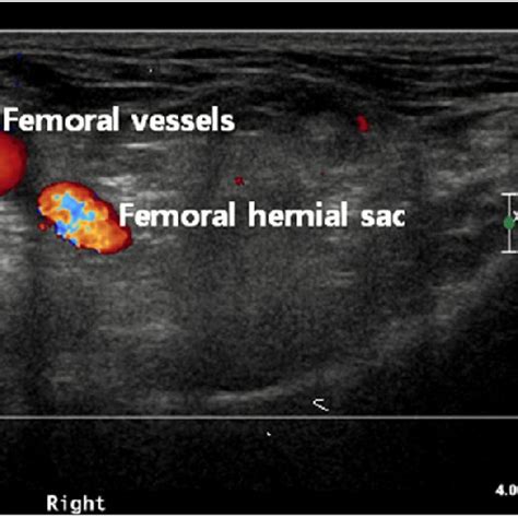 The Ct Finding Of Left Femoral Hernia There Are Typical Findings Of